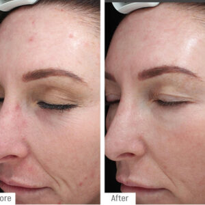 Unrealistic anti-ageing or body promise? Case results for wrinkles and breakout skin treatment at Temple Skincare