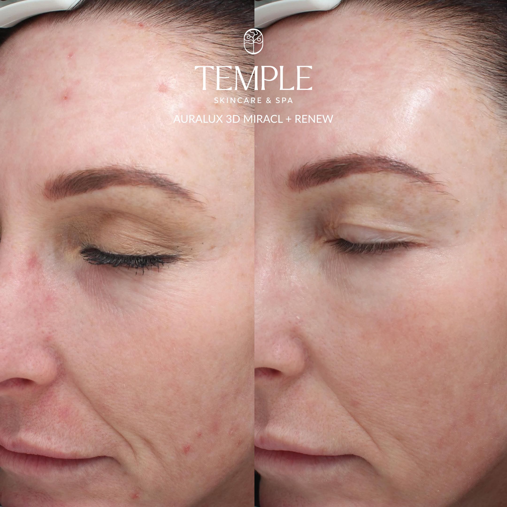 AURALUX 3D MIRACL Before and After Temple Skincare & Spa Castle Hill NSW