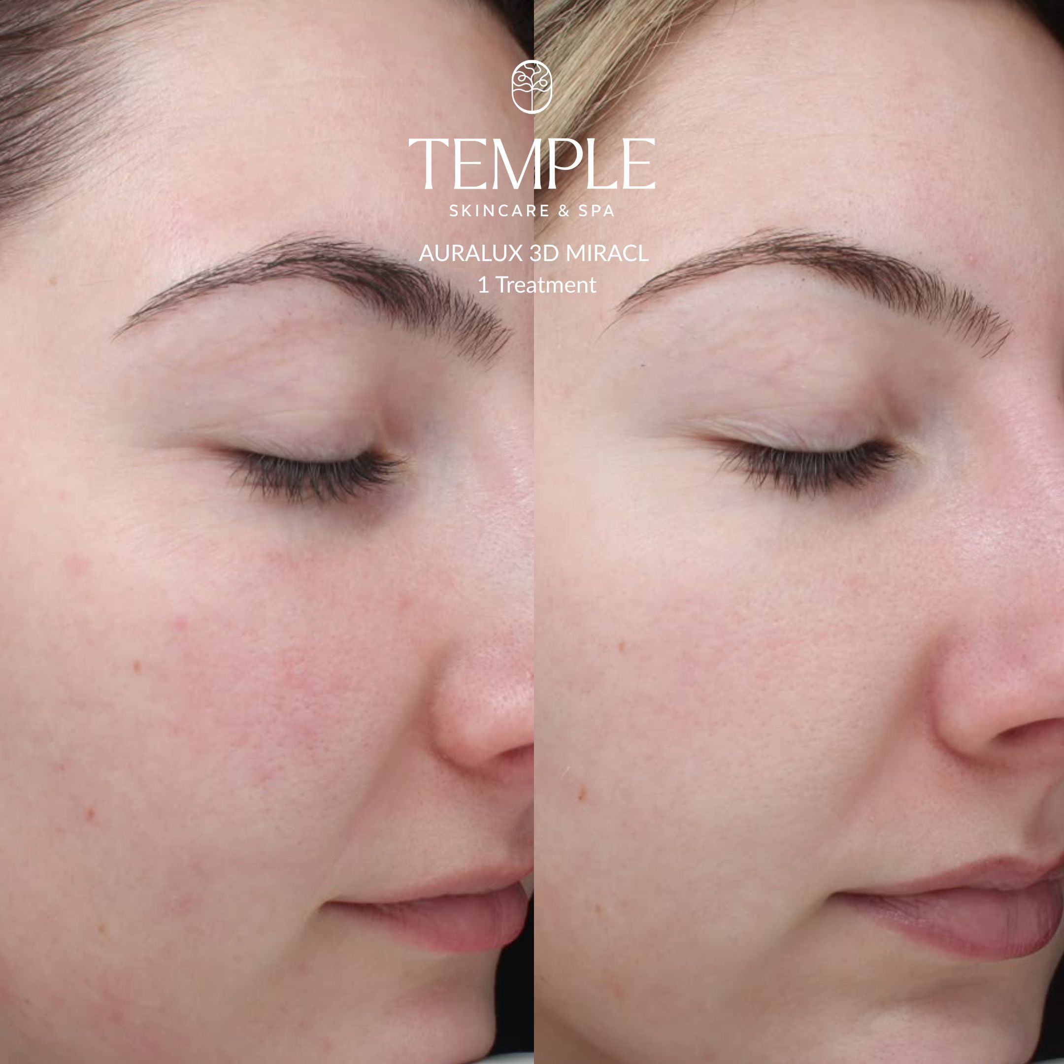 AURALUX 3D MIRACL Before and After Temple Skincare & Spa