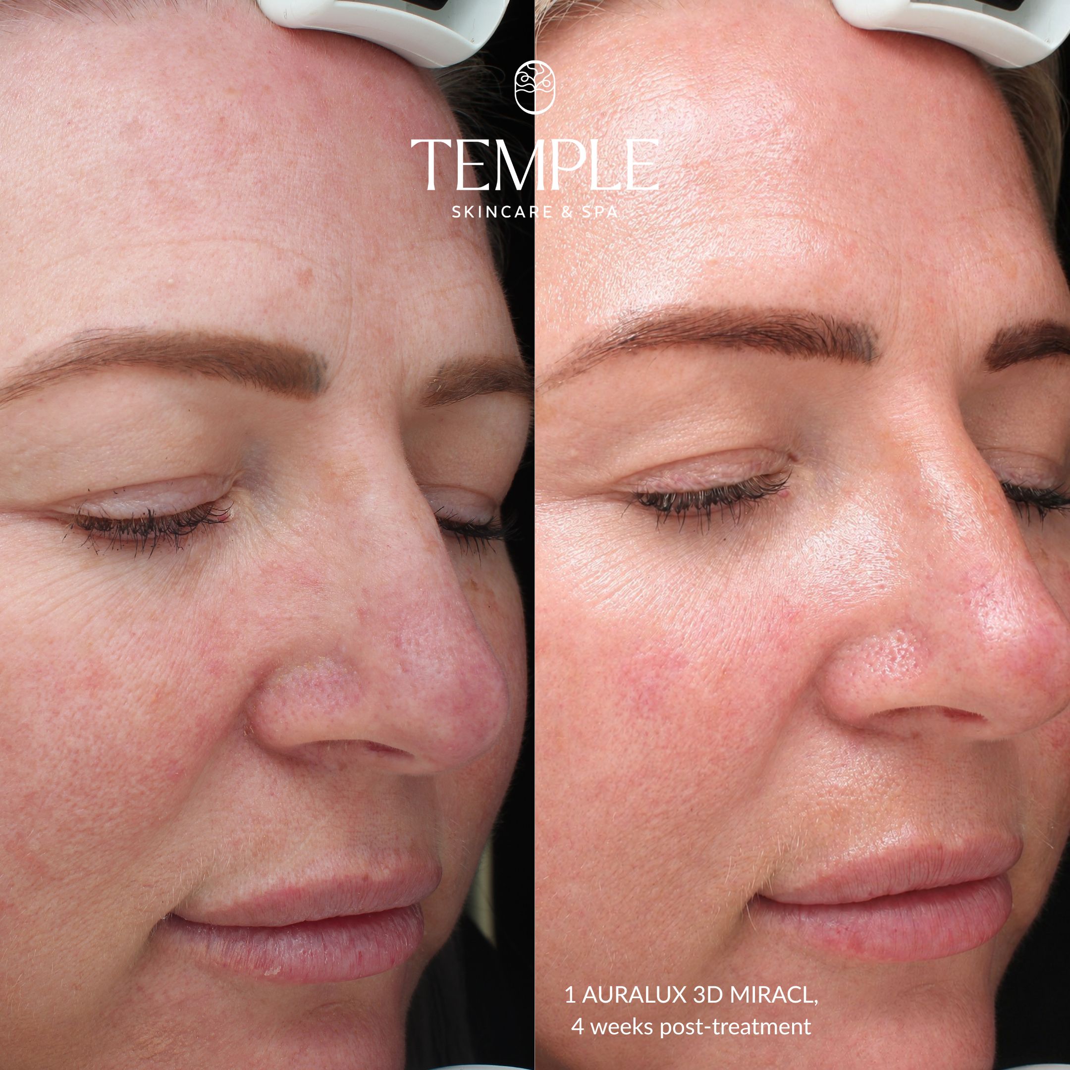 Auralux Before and After Temple Skincare & Spa (1)