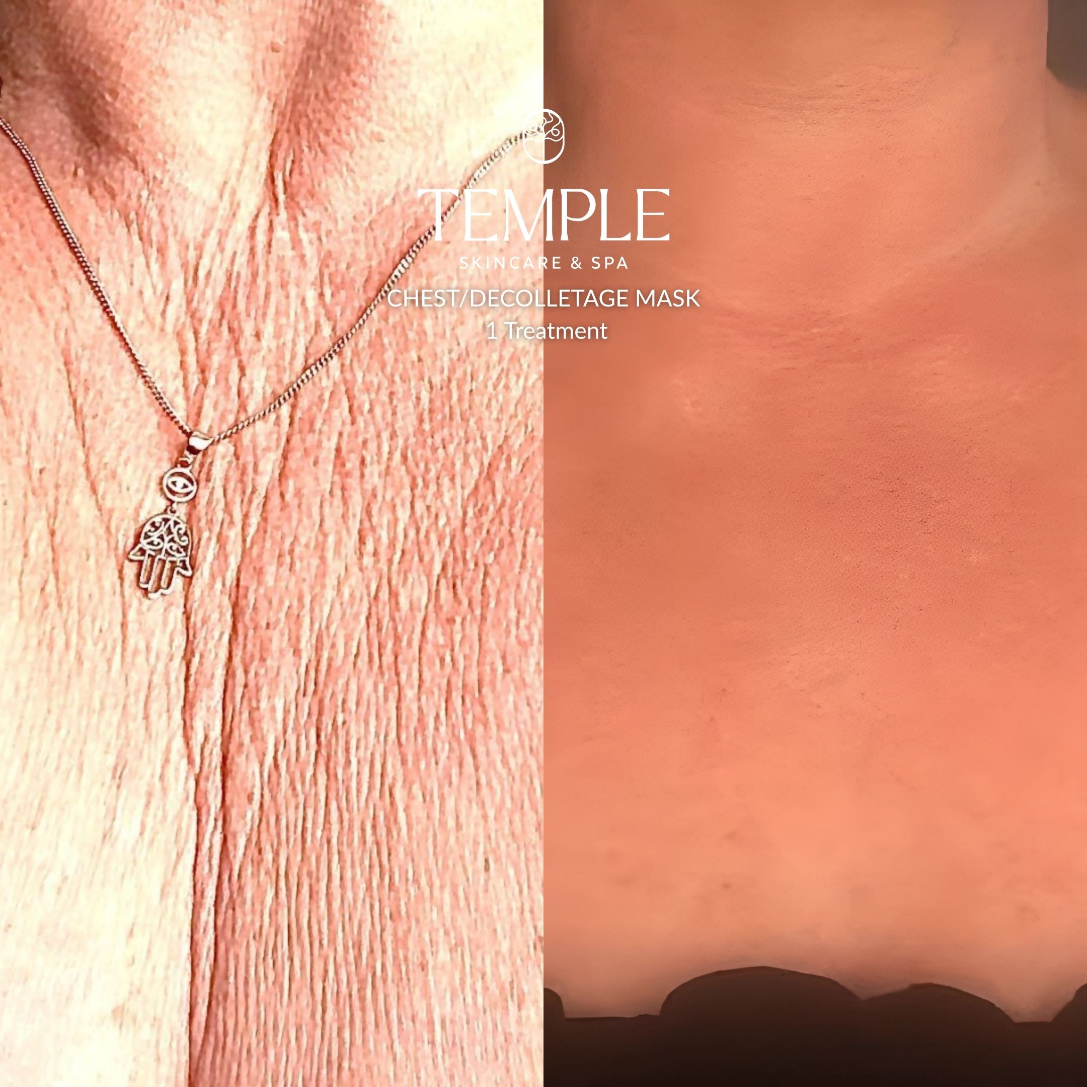 Chest Decolletage Before and After Temple Skincare & Spa