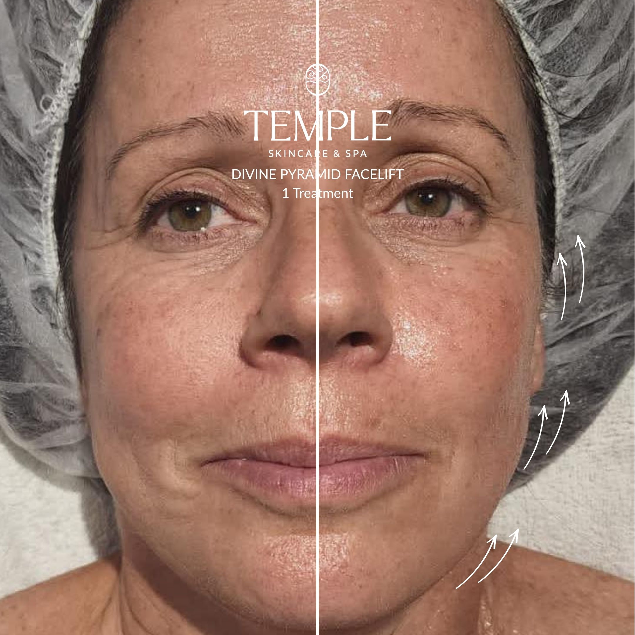 Divine pyramid facelift Before and After Temple Skincare & Spa (5)