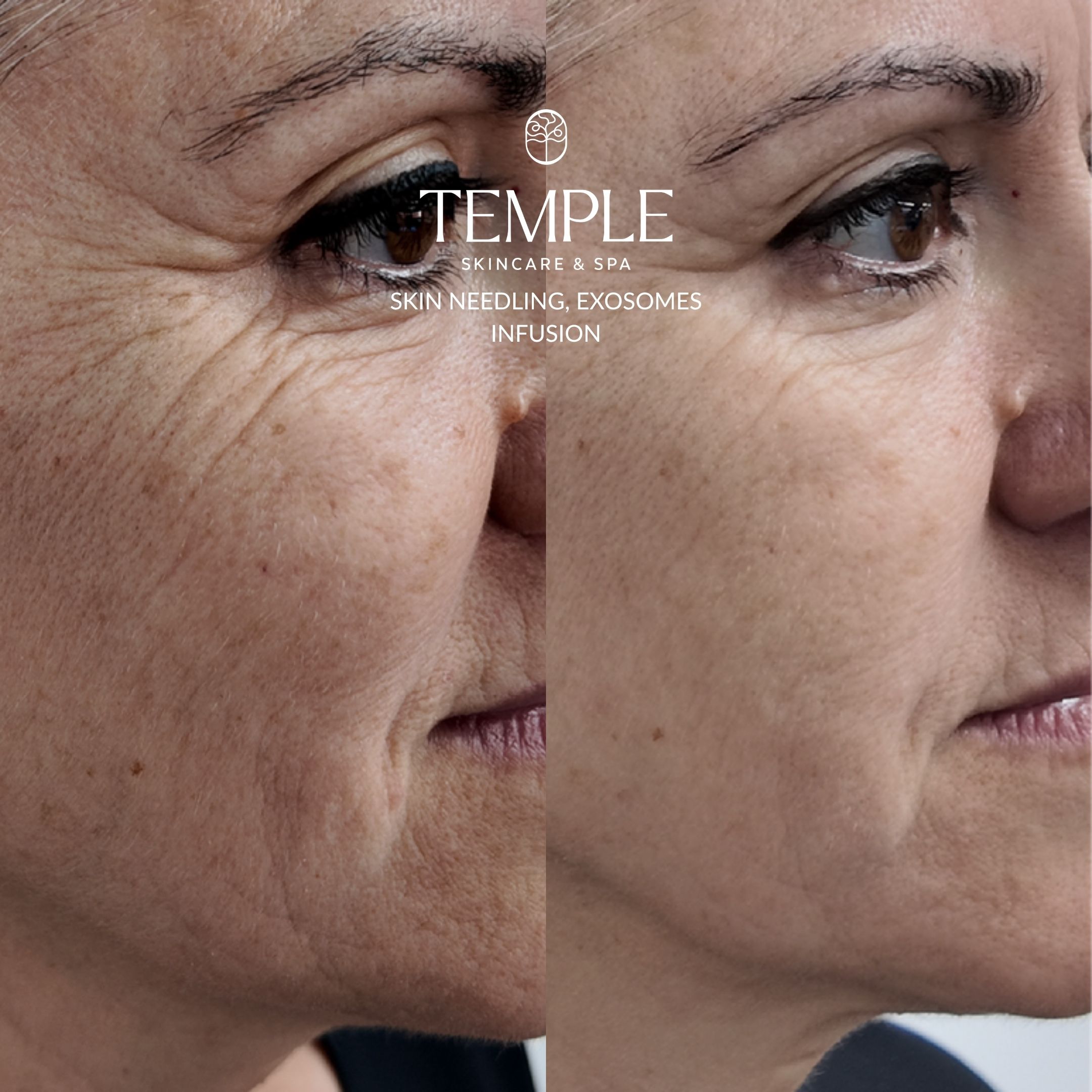 _Exosomes Infusion Before and After Temple Skincare & Spa