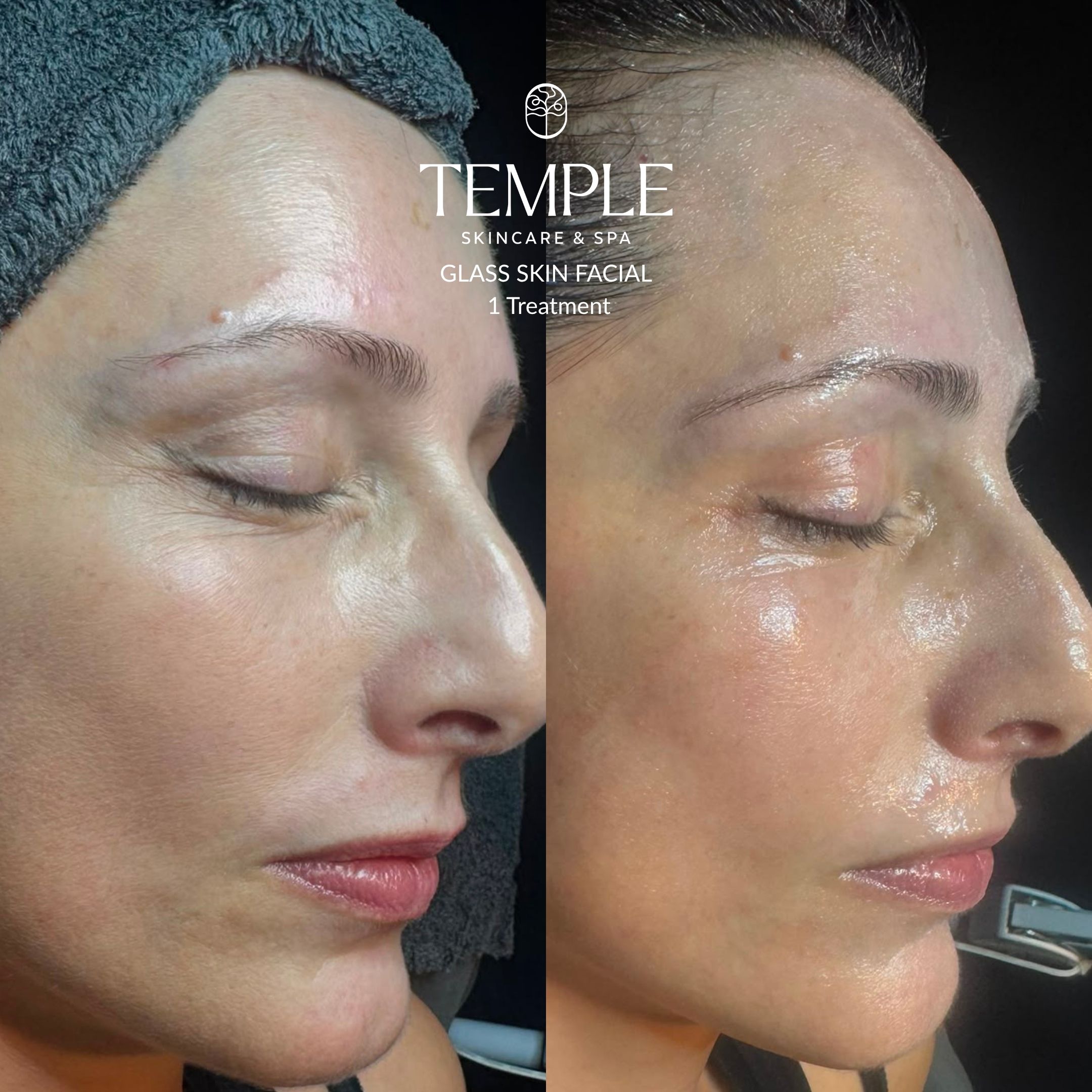 Glass Skin Facial Before and After Temple Skincare & Spa (2)