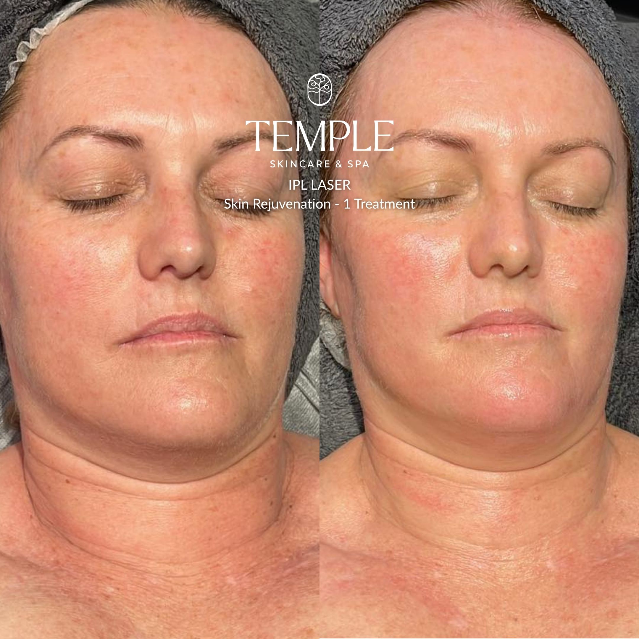 IPL Laser Before and After Temple Skincare & Spa (1)