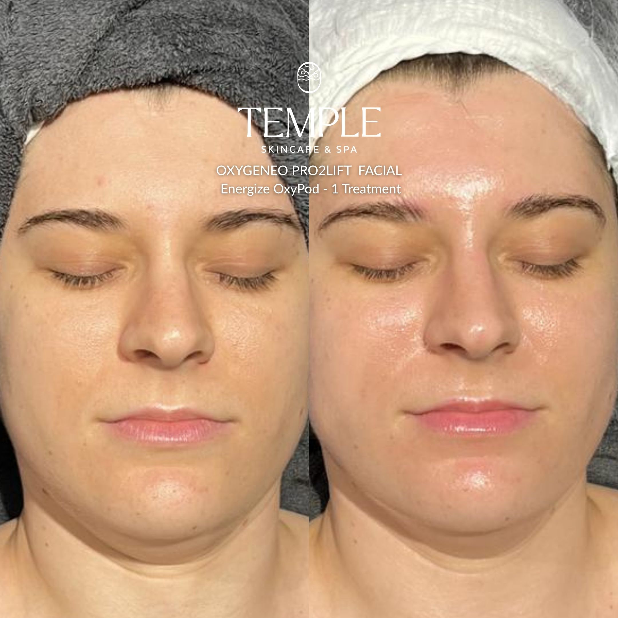 Oxygeneo Energize Facial Before and After Temple Skincare & Spa (2)