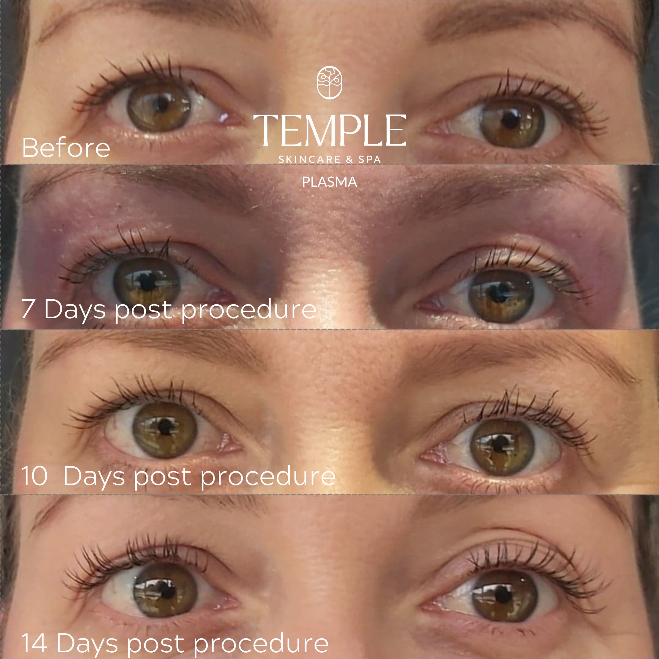 Plasma Pen Anti-ageing Facial The Temple Skincare & Spa Castle Hill NSW (1)
