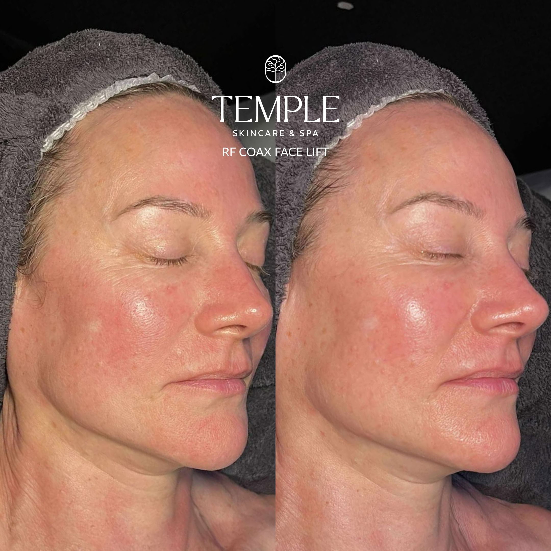 _RF Coax Face Lift Before and After Temple Skincare & Spa (1)