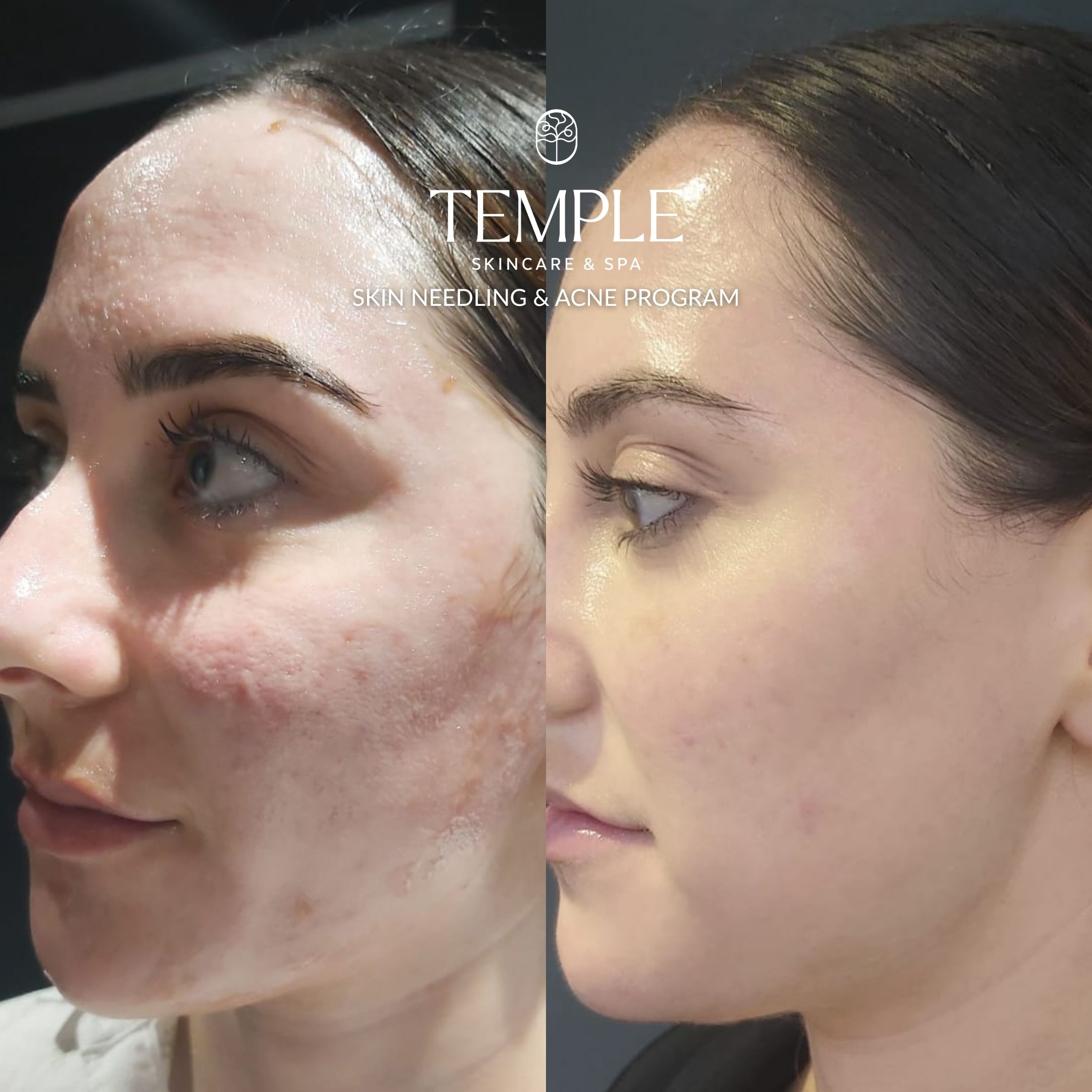 Skin Needling & ACNE PROGRAM Temple Skincare & Spa