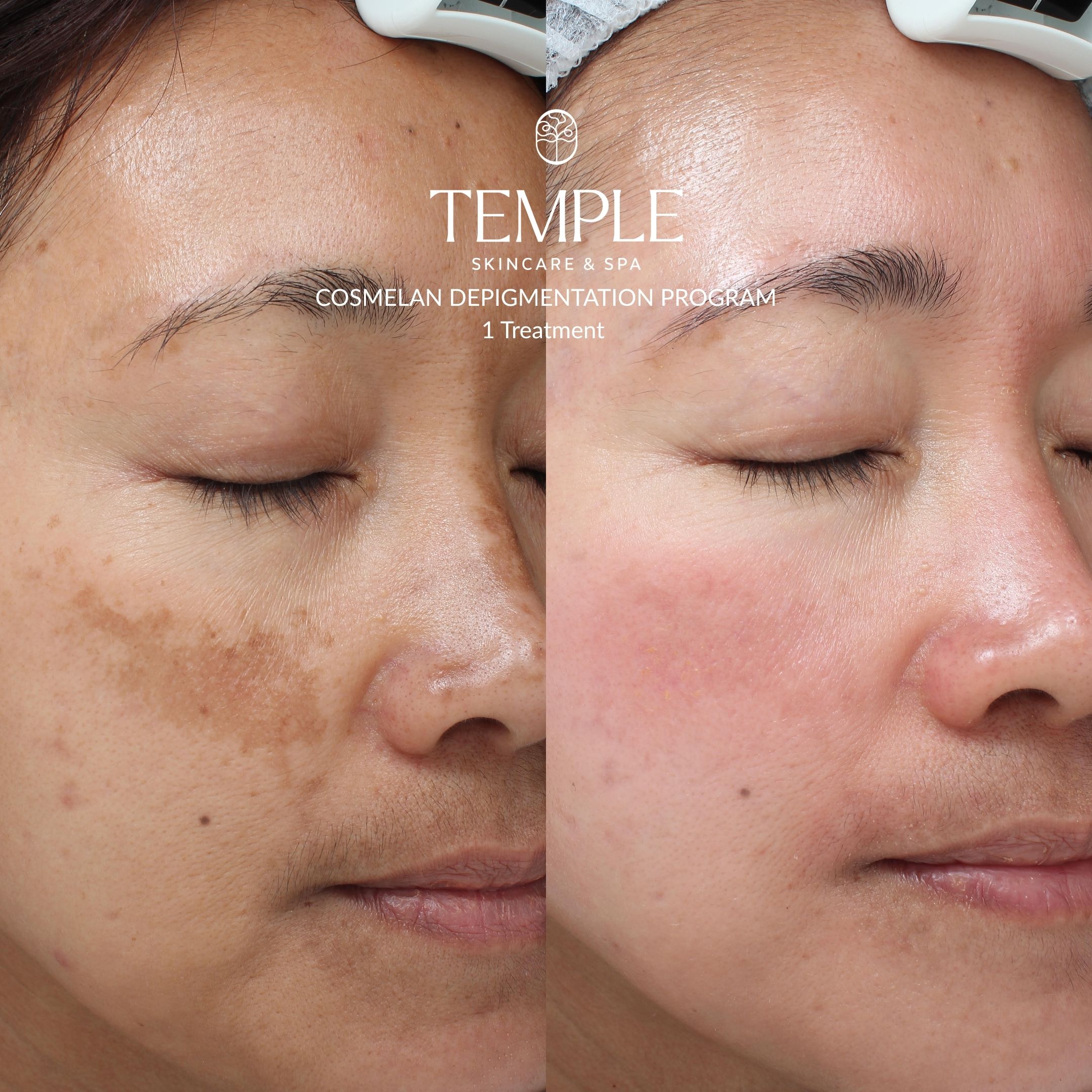 before and after Cosmelan Depigmentation Program Temple Skincare & Spa
