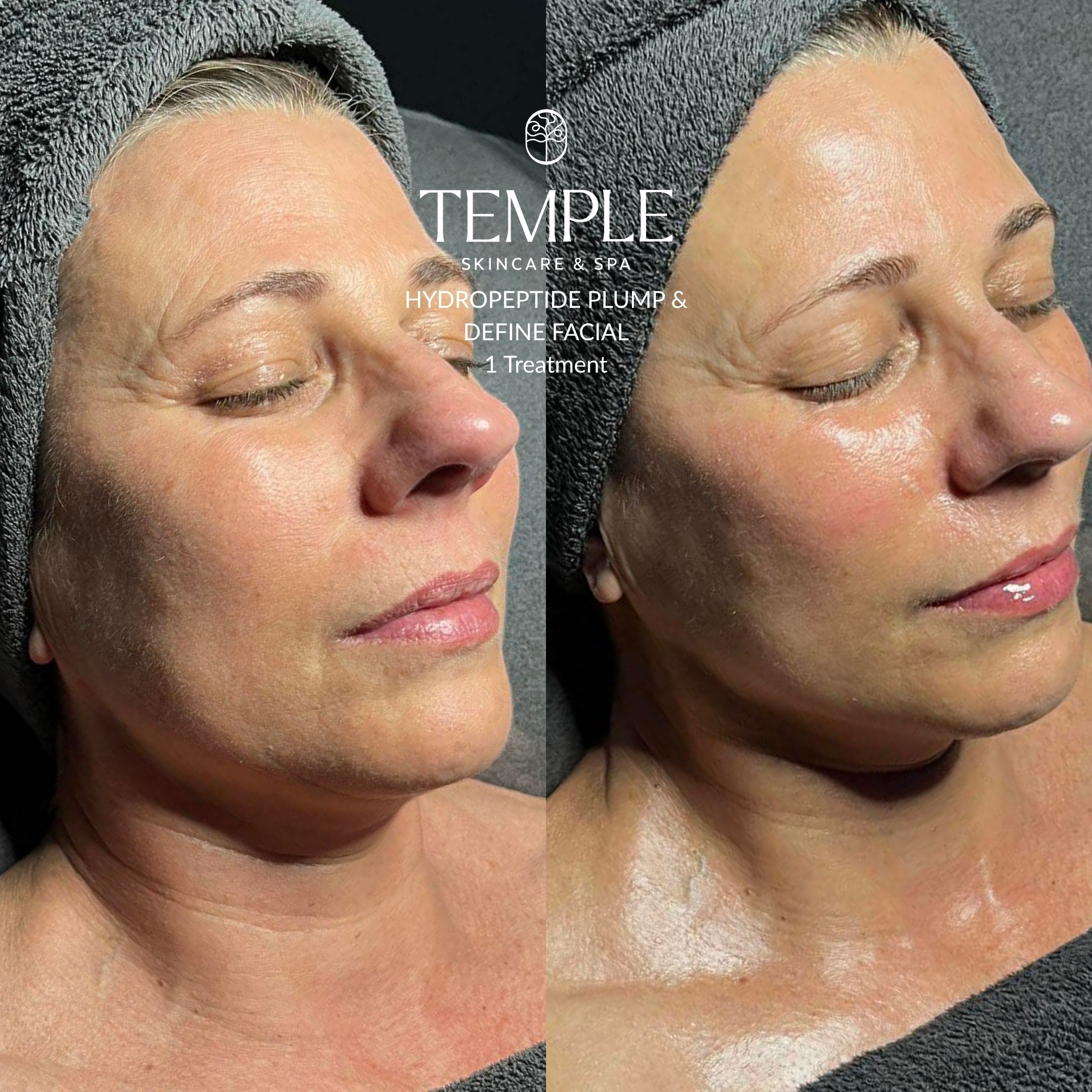 hydropeptide plump and define facial Before and After Temple Skincare & Spa (2)