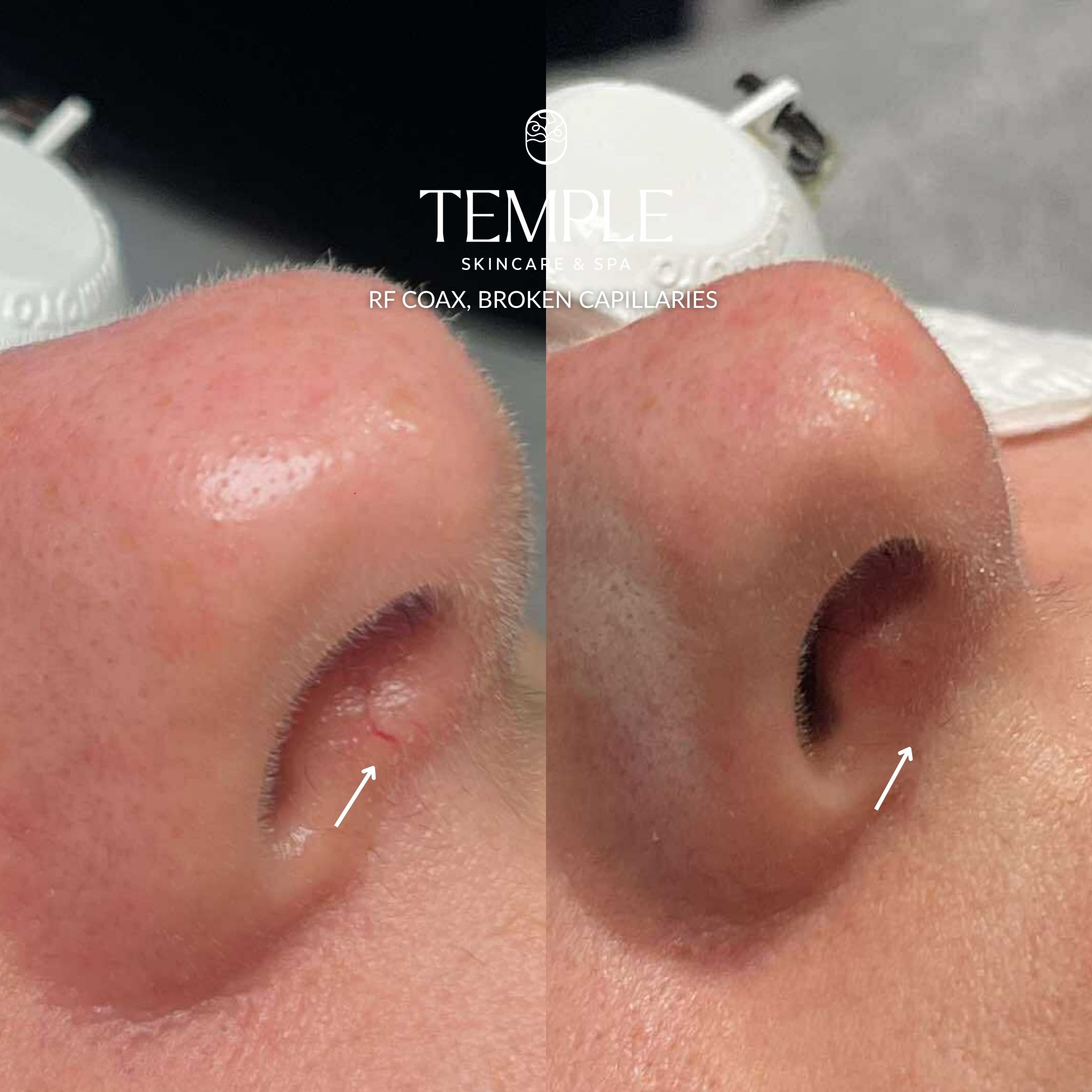 Broken Capillaries Laser Before and After Temple Skincare & Spa (1)