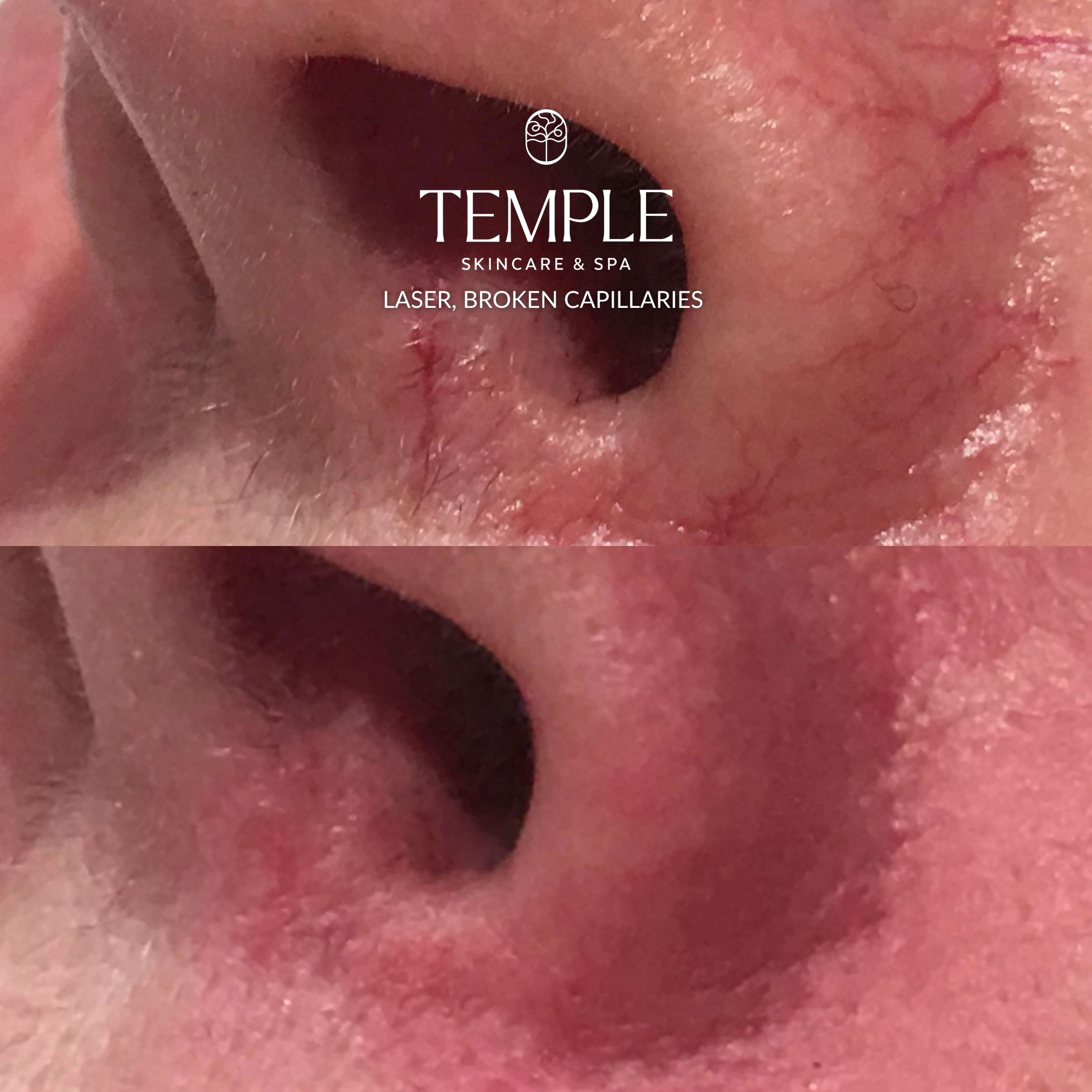 Broken Capillaries Laser Before and After Temple Skincare & Spa (2)