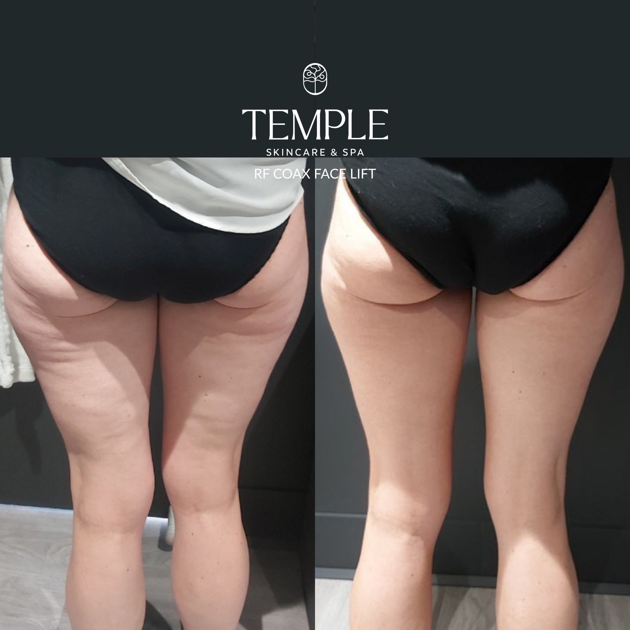 Copy of RF Coax Face Lift Before and After Temple Skincare & Spa
