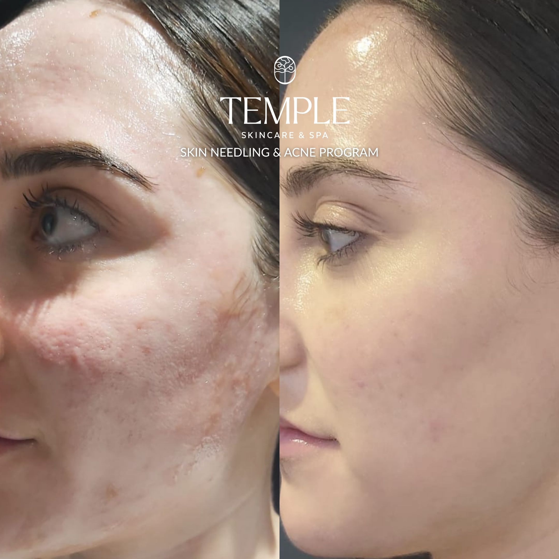 Skin Needling & ACNE PROGRAM Temple Skincare & Spa (1)