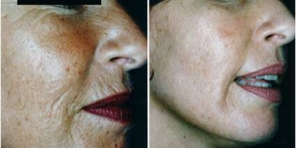CITLIPLINES