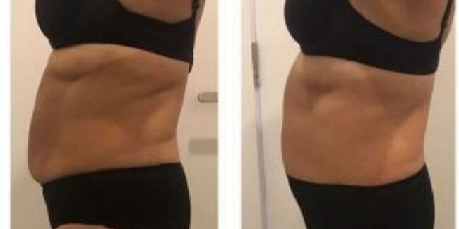 before and after lymphatic drainage