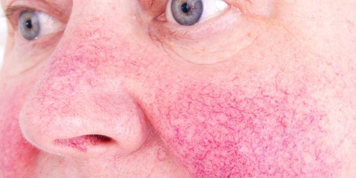 rosacea