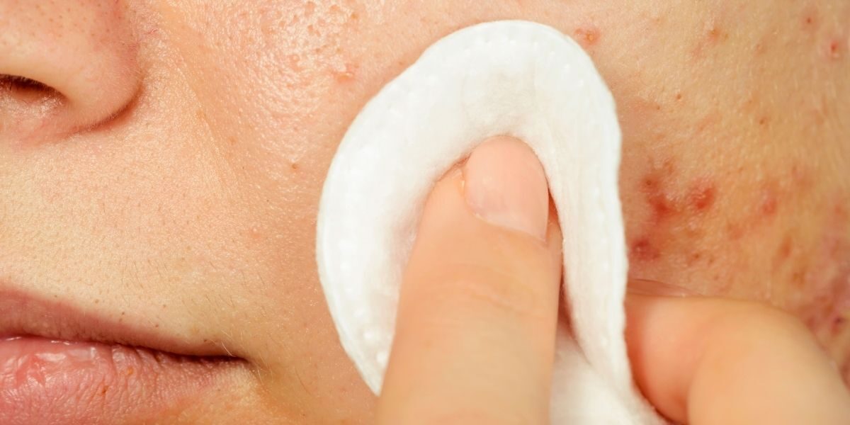 Adult Acne: the Struggle is Real!
