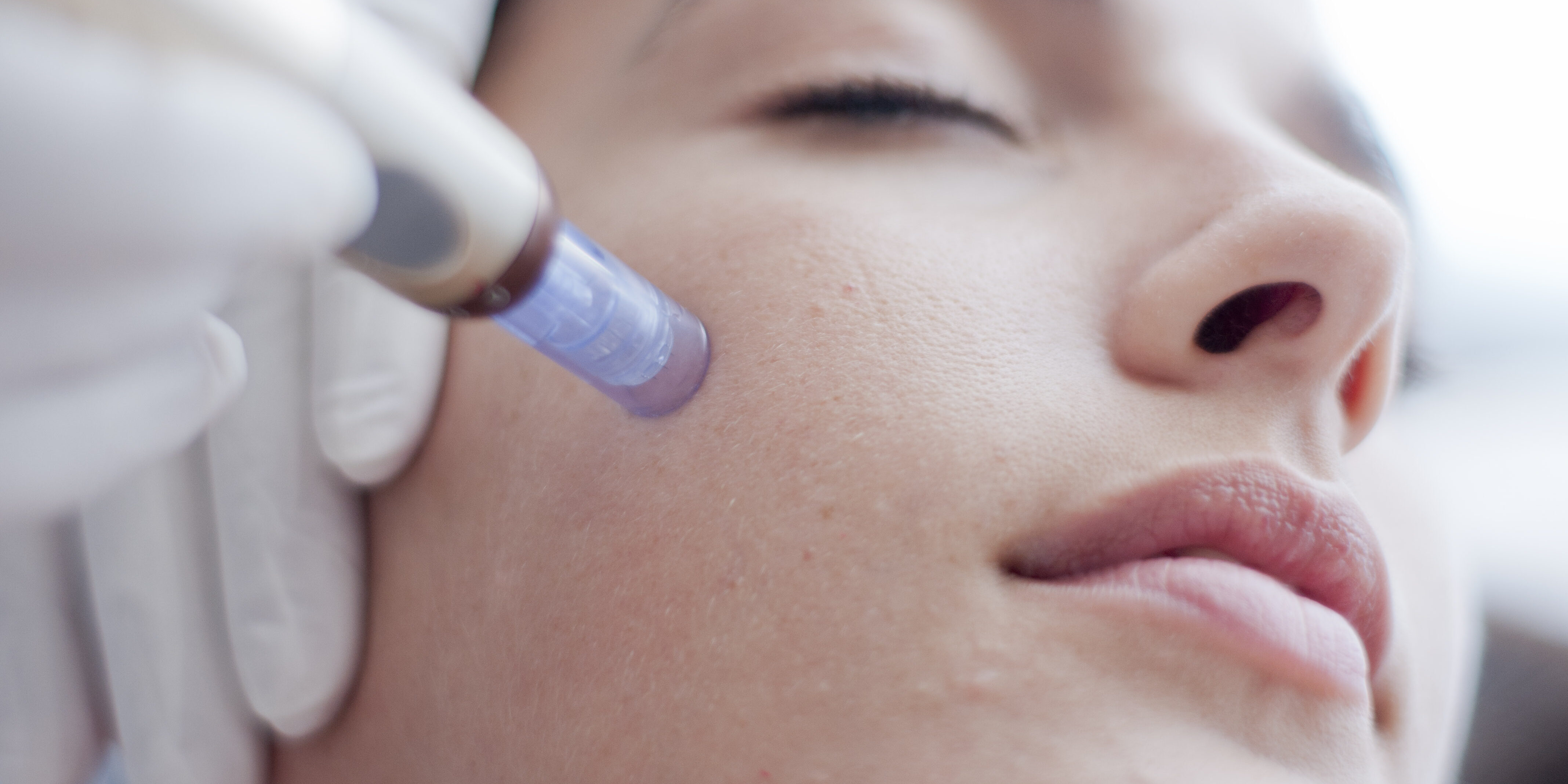 skin-needling