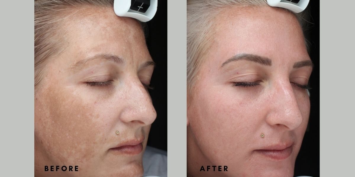 cosmelan B&A Client B