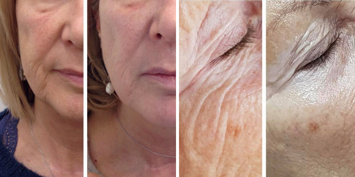 HIFU lifting Temple Skincare