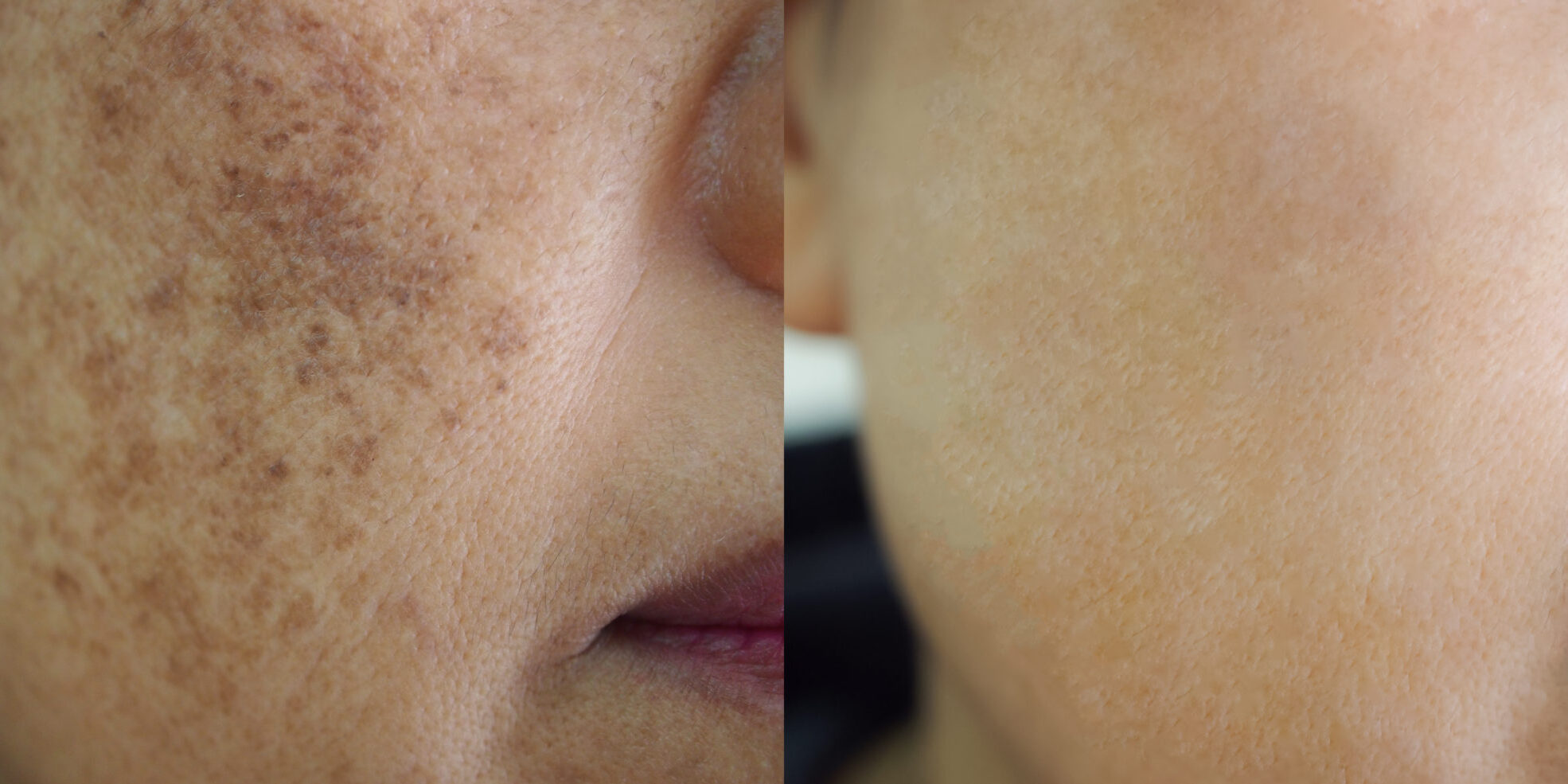 pigmentation before and after temple skincare