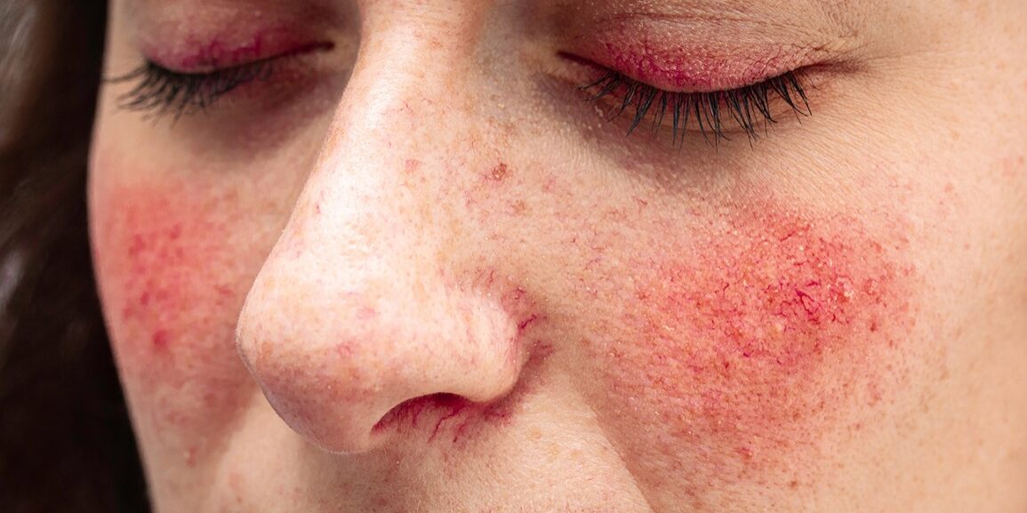 facing rosacea temple skincare & spa