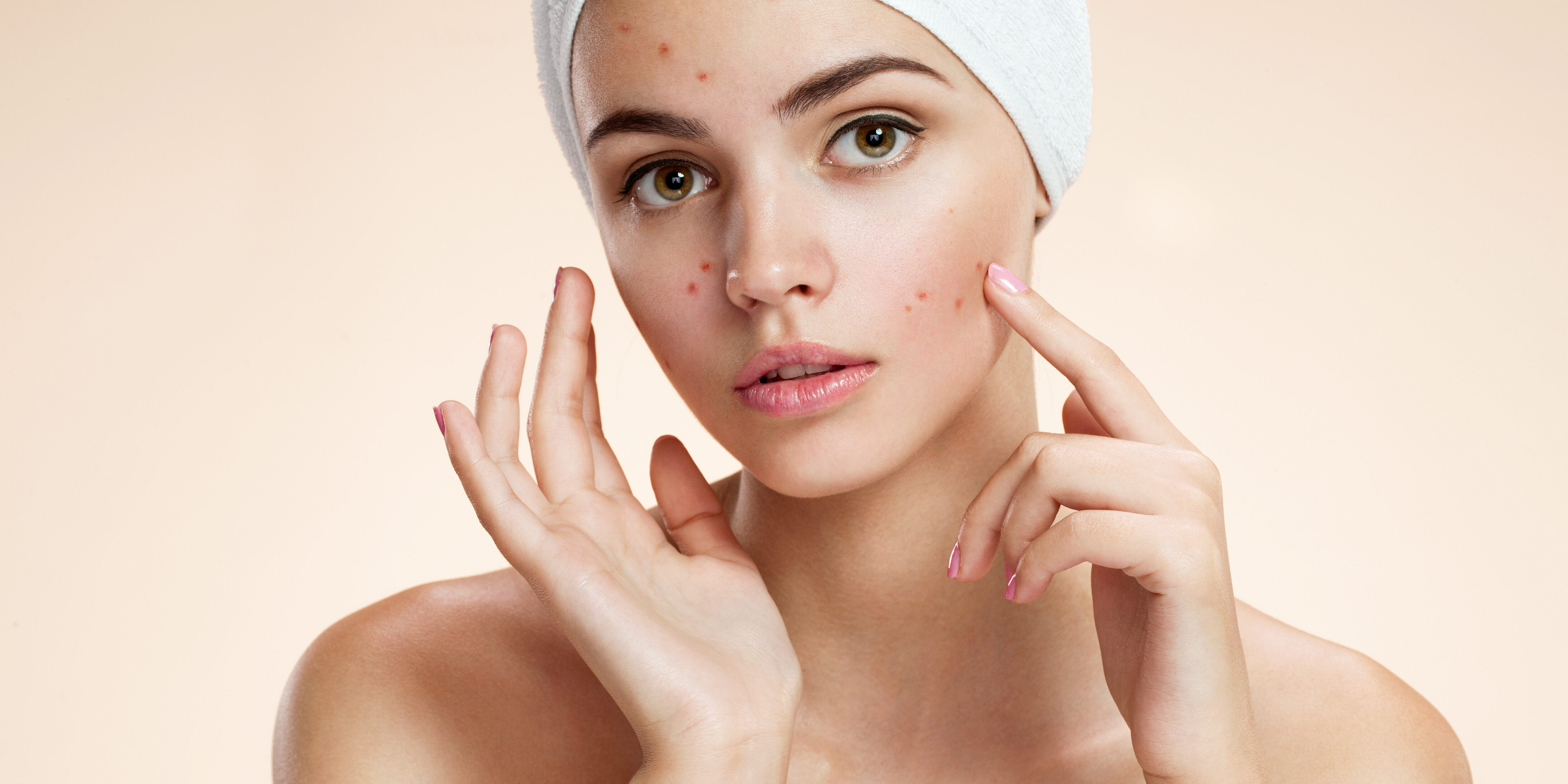 can facials solve acne