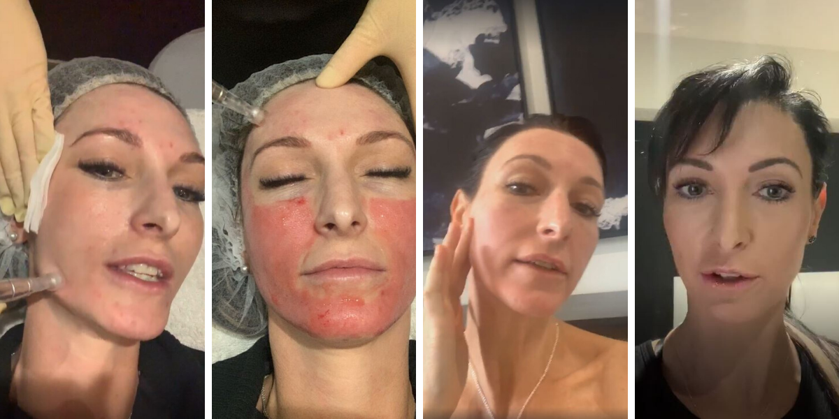 skin needling temple skincare