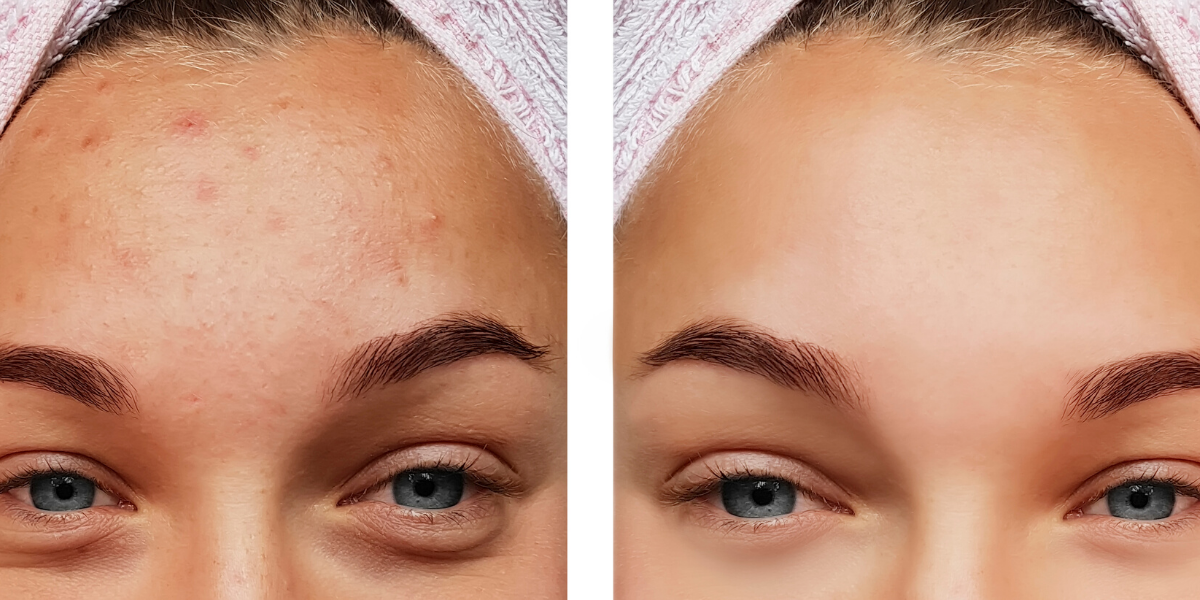 what causes acne